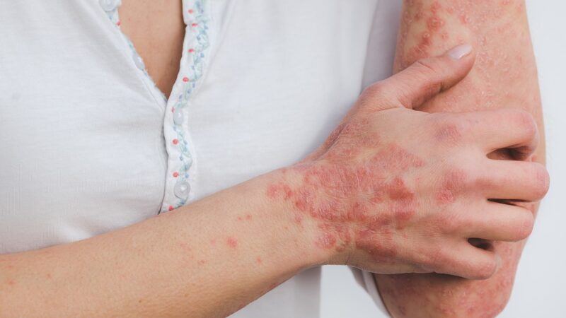 Santé de la Peau : Lutter contre l’Eczéma et le Psoriasis