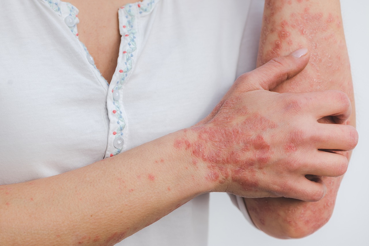 Santé de la Peau : Lutter contre l’Eczéma et le Psoriasis